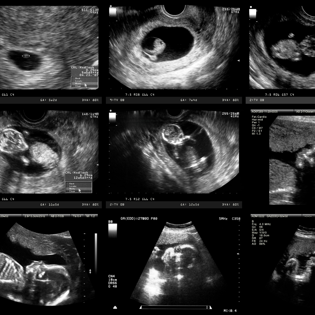 Do I need an ultrasound before my abortion?